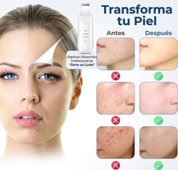 Pala Limpieza Facial Ultrasónica Peeling Profundo.